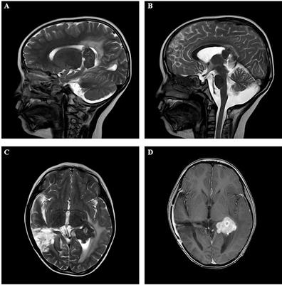 Paediatric Erdheim-Chester Disease in the Lateral Ventricle: A Case Report and Review of the Literature